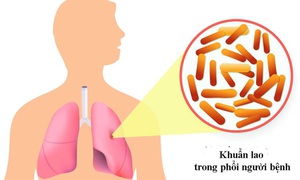 Hiểu về bệnh HIV tiến triển: Nguy cơ và cách quản lý hiệu quả