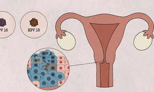 5 nh&#243;m phụ nữ n&#234;n ch&#250; &#253; kh&#225;m s&#224;ng lọc ung thư cổ tử cung