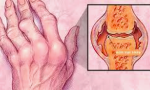 Vi&#234;m khớp dạng thấp ảnh hưởng đến cơ thể như thế n&#224;o?