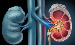  C&#225;ch điều trị bệnh sỏi thận đ&#250;ng cần biết