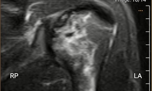 Thợ lặn biển hơn 20 năm bị hoại tử xương c&#225;nh tay, xương đ&#249;i