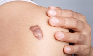 Chữa sẹo lồi c&#243; kh&#243; kh&#244;ng?