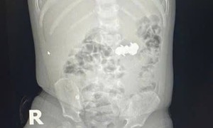 B&#233; trai nuốt 4 vi&#234;n đinh nam ch&#226;m đầu nhọn nguy hiểm
