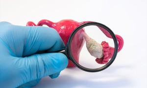 Dấu hiệu buồng trứng đa nang thường gặp