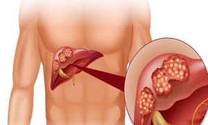 Cảnh&#160;gi&#225;c&#160;với&#160;gi&#227;n&#160;tĩnh&#160;mạch&#160;thực&#160;quản