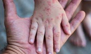 Dịch sởi bùng phát mạnh tại Mỹ, hàng trăm trẻ em phải cách ly