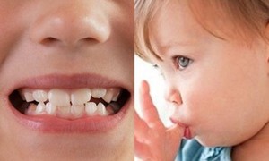 Điều trị sớm khớp cắn ngược răng sữa ở trẻ