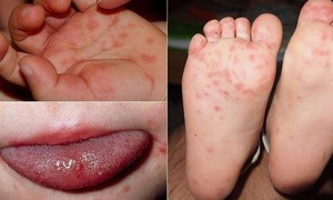 Bệnh tay ch&#226;n miệng d&#249;ng thuốc như thế n&#224;o?