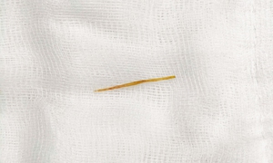 Thủng ruột do thói quen rất nhiều người mắc