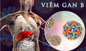 Bỏ điều trị viêm gan B mạn tính, người đàn ông nguy kịch phải ghép gan cấp cứu