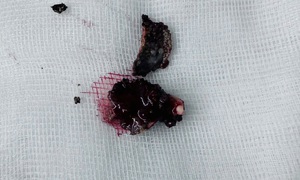 Bác sĩ lấy dị vật vôi hóa tồn tại nhiều năm trong mũi bệnh nhân