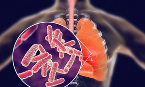 Thời gian ủ bệnh viêm phổi bao lâu?