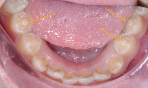 Răng c&#243; n&#250;m phụ – nguy cơ biến chứng nếu kh&#244;ng điều trị kịp thời