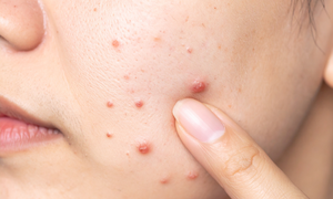 Thủ phạm&#160;g&#226;y&#160;mụn&#160;ở&#160;thời&#160;kỳ&#160;m&#227;n&#160;kinh