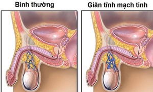 Gi&#227;n tĩnh mạch thừng tinh: Nguy&#234;n nh&#226;n, biểu hiện, c&#225;ch điều trị v&#224; ph&#242;ng bệnh