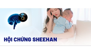 Hội chứng Sheehan: Nguy&#234;n nh&#226;n, triệu chứng, c&#225;ch điều trị v&#224; ph&#242;ng ngừa