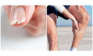 8 dấu hiệu cảnh báo cơ thể thiếu canxi cần bổ sung ngay