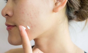 Da mụn nên trang điểm thế nào vừa che khuyết điểm vừa không gây bí da?