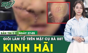 Bản tin Y tế 27/5: Giòi 'làm tổ' trong khối u trên mặt cụ bà 88 tuổi ở Quảng Nam