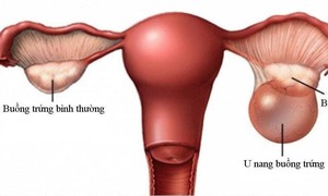 Biến chứng nguy hiểm của u nang buồng trứng