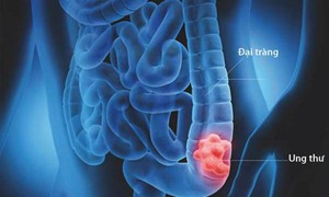 5 b&#237; quyết giảm nguy cơ mắc ung thư đại tr&#224;ng