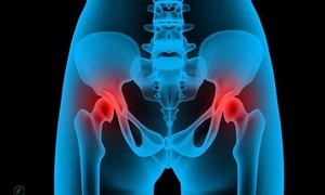 Triệu chứng sớm của thoái hóa khớp háng