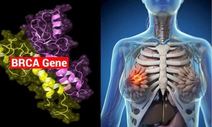 7 yếu tố nguy cơ gây bệnh ung thư vú