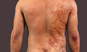 Biến chứng zona không thể chủ quan
