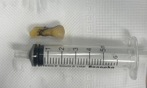 Gắp chiếc răng của cụ ông bị đột quỵ não rơi vào đường thở