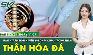 Bản tin Y tế 11/7: Hai b&#234;n thận người đ&#224;n &#244;ng bị bịt k&#237;n bởi h&#224;ng trăm ngh&#236;n vi&#234;n sỏi 