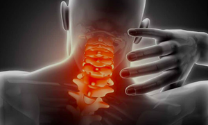 Đau cổ vai g&#225;y c&#243; thể bị liệt nếu điều trị sai c&#225;ch