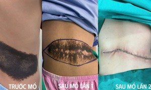 Phẫu thuật th&#224;nh c&#244;ng khối u sắc tố khổng lồ ở lưng b&#233; 8 tuổi