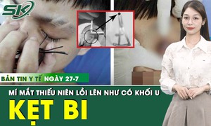 Bản Tin Y Tế 27/7: Viên bi sắt 6cm kẹt trong mí mắt thiếu niên 15 tuổi