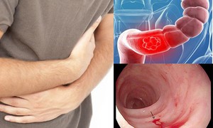 Phát hiện mắc ung thư sau 3 tháng rối loạn tiêu hóa
