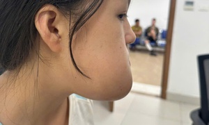 Phẫu thuật loại bỏ khối u, lấy lại thẩm mỹ khuôn mặt cho cô gái 16 tuổi
