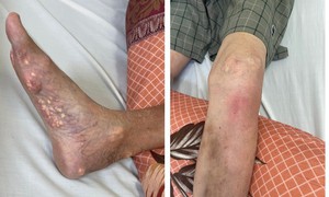 Tự ý mua thuốc của thầy lang để chữa gout, bệnh nhân bị suy tuyến thượng thận