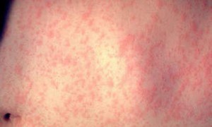 Số ca mắc bệnh sởi tại châu Mỹ tăng mạnh