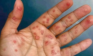 X&#233;t nghiệm chẩn đo&#225;n v&#224; điều trị bệnh giang mai
