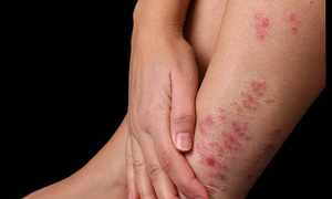 Phát hiện sớm bệnh ngoài da mùa mưa lũ
