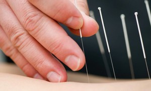 Châm cứu để chữa đau lưng