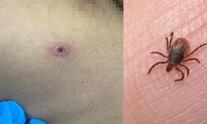Người đ&#224;n &#244;ng bị sốt k&#233;o d&#224;i, suy h&#244; hấp nặng, rối loạn đ&#244;ng m&#225;u do sốt m&#242;
