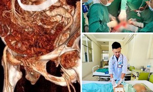Phẫu thuật cứu sống kịp thời bệnh nh&#226;n 86 tuổi vỡ ph&#236;nh động mạch chủ bụng