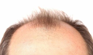 Đồ uống có đường - 'thủ phạm' gây rụng tóc ở nam giới