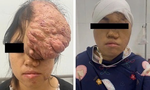 'Giải cứu' cô gái Mông mang khối u khổng lồ 25 × 35 cm vùng đỉnh trán