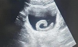 Người đàn ông phải nhập viện cấp cứu vì… đỉa sống trong bàng quang