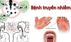 Dịch bệnh truyền nhiễm gia tăng, ngành Y tế Lâm Đồng tăng cường các biện pháp phòng, chống