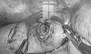 Phẫu thuật nội soi cấp cứu thành công cho nam thanh niên bị đinh xuyên thủng ruột non 