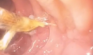 Thủng tá tràng do thói quen ngậm tăm xỉa răng