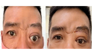 Bệnh hiếm gây lồi mắt, 20 năm Bệnh viện Tai Mũi Họng TPHCM chỉ gặp 2 ca