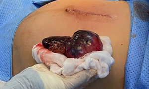 Thai phụ 34 tuần nguy kịch vì u buồng trứng xoắn hoại tử